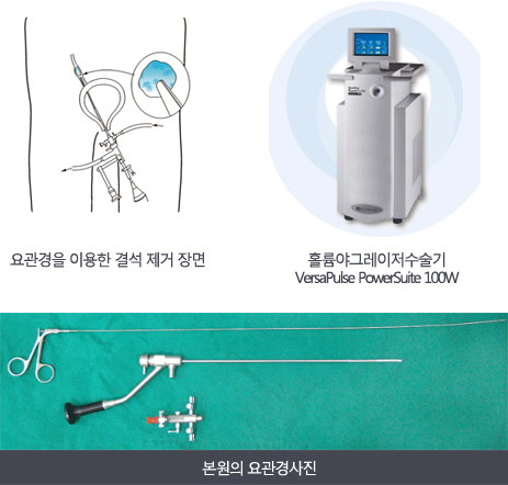 본원의 요관경 사진